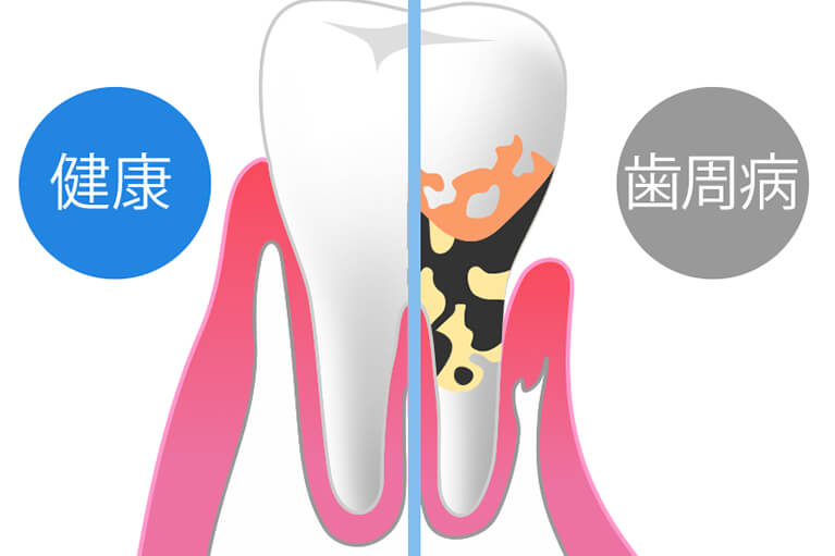 歯を失う原因の第1位は歯周病